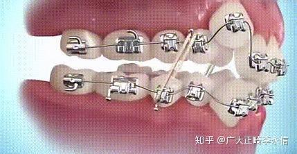 安装牙齿视频,视频详解